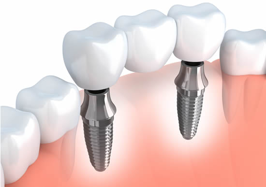 tooth implant West Roxbury