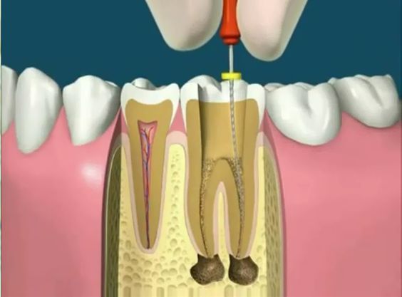 Root Canal Therapy Boston