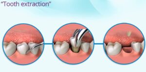 wisdom tooth extraction West Roxbury